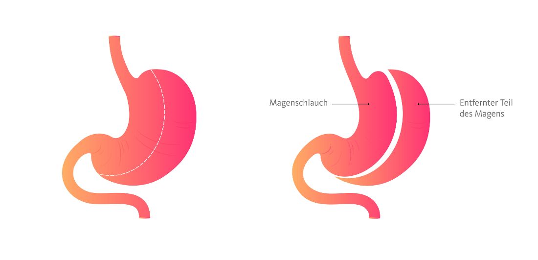 Magenschlauch_iruy9aj3xfev.jpg