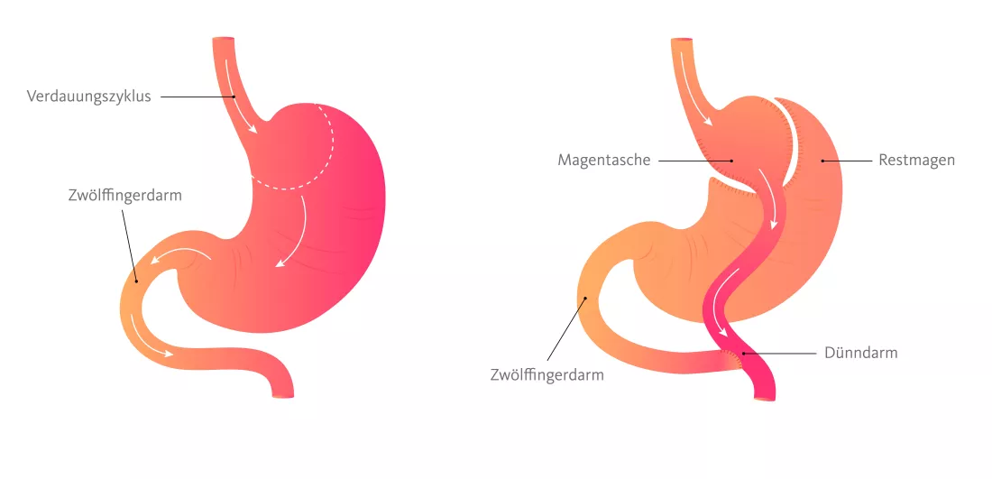 Magenbypass_1dmrel2y8a0kh.jpg